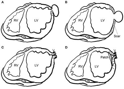 Surgical and Conservative Treatment of Post-infarction Left Ventricular Pseudoaneurysm